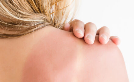 Patientin mit Lichtschaden an der Haut.