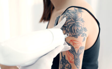 Arzt entfernt Tattoos.