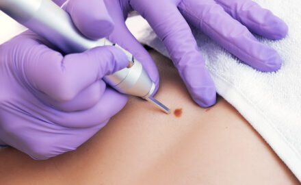 Arzt entfernt Tumor von der Haut.