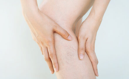 Venenerkrankung am Bein.