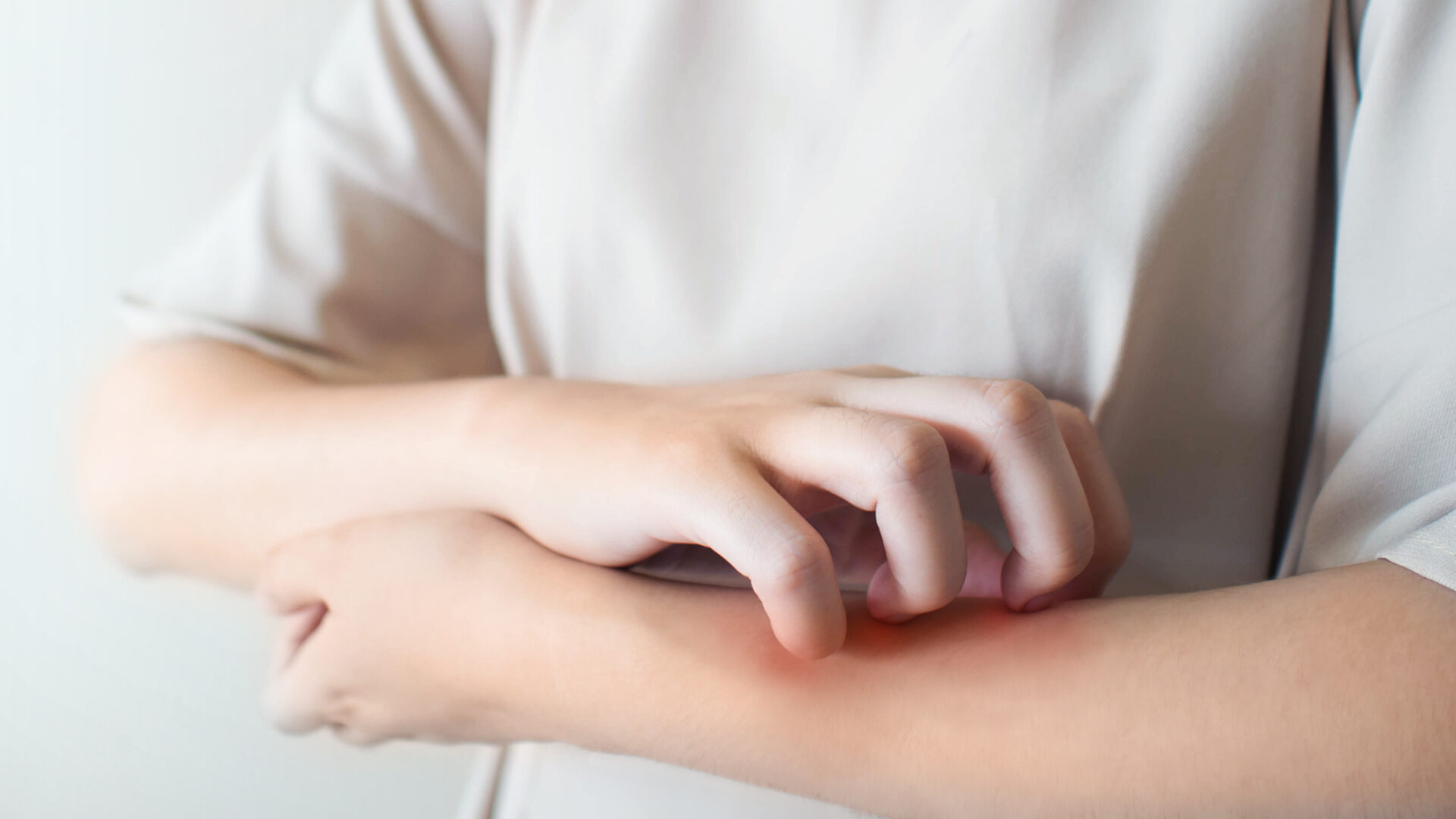 Person mit allergischer Reaktion am Arm.