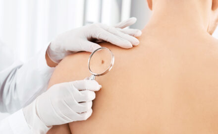 Arzt untersucht Patient auf Hautkrebs und Muttermalen.