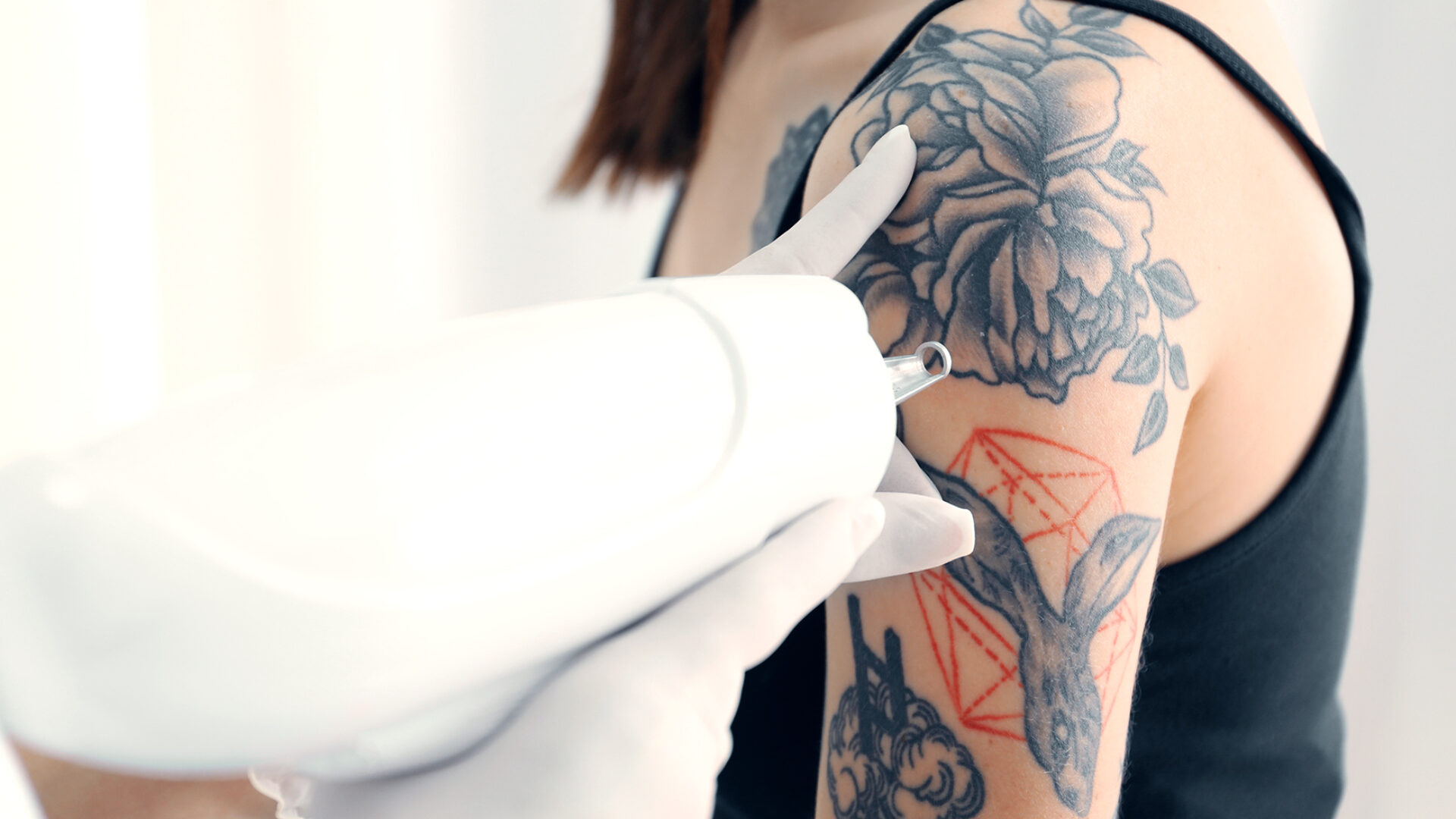 Entfernung von Tattoos.
