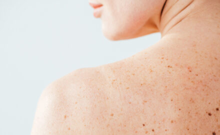 Haut und Schulter einer Patientin mit Muttermalen und Pigmentflecken.