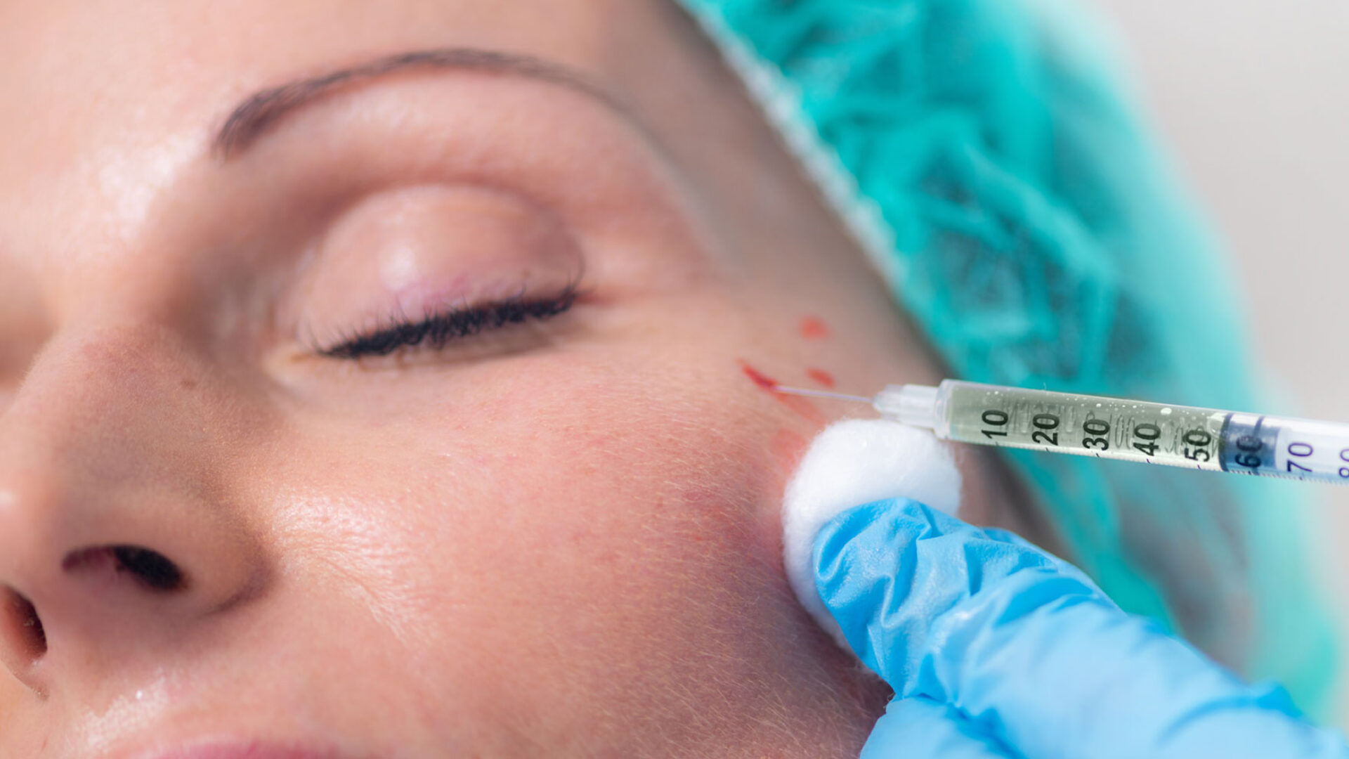 Faltenbehandlung mit PRP-Therapie