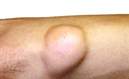 Unterarm mit Fettgewebswucherung.