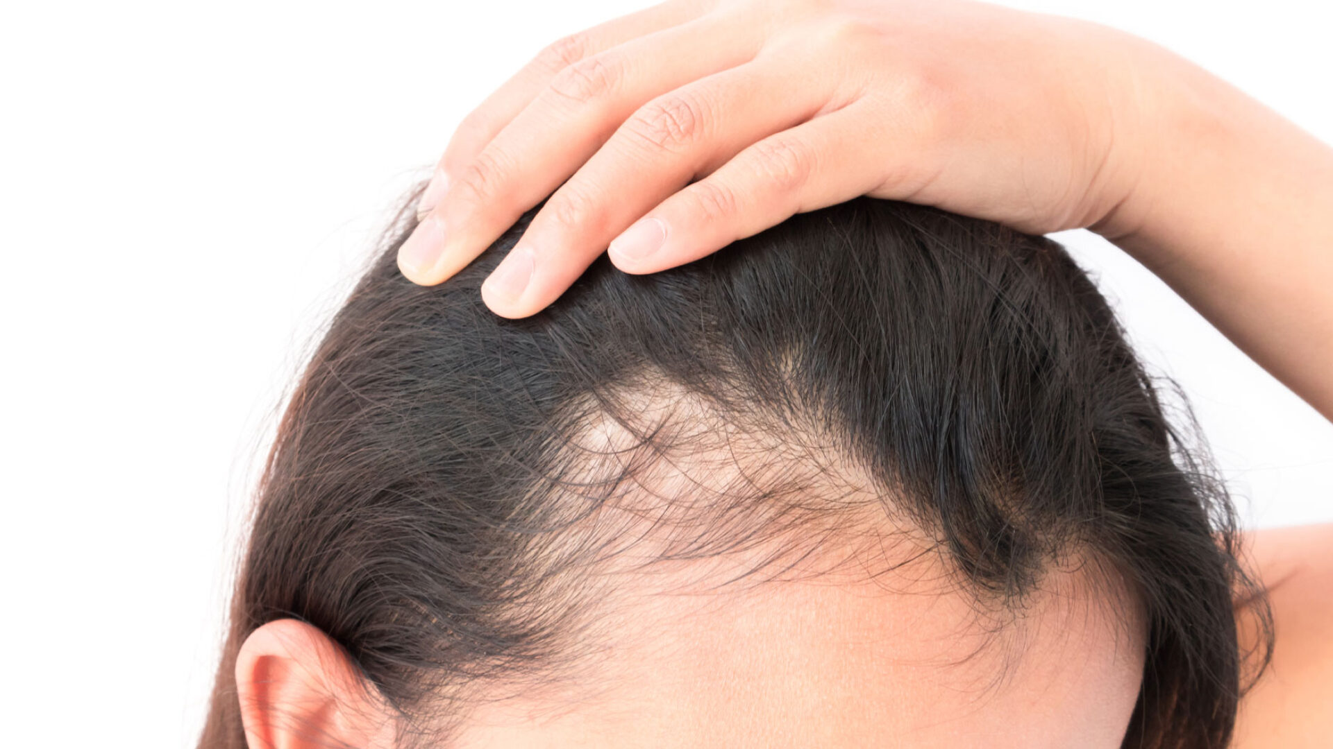 Frau mit Haarausfall