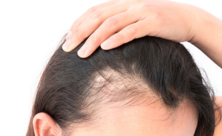 Frau mit Haarausfall