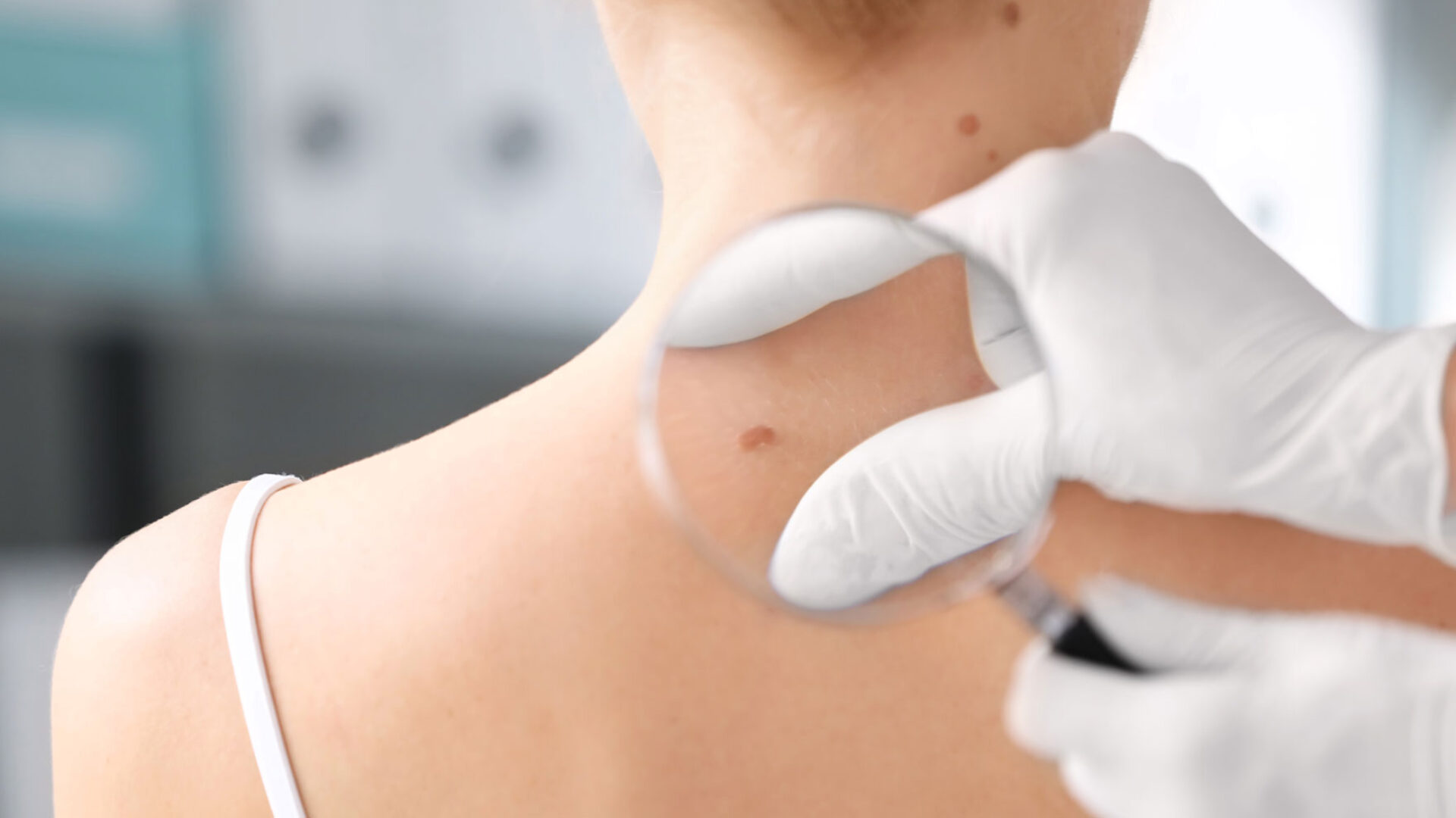Untersuchung von Hauttumor