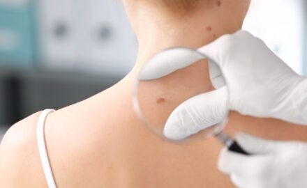 Untersuchung von Hauttumor