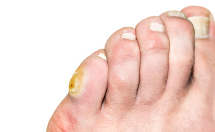 Fuß mit Hühneraugen und Ekzem Befall.