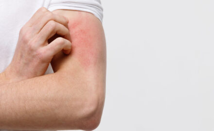 Oberarm mit starkem Juckreiz.