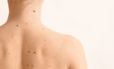 Rücken mit vielen Muttermalen.