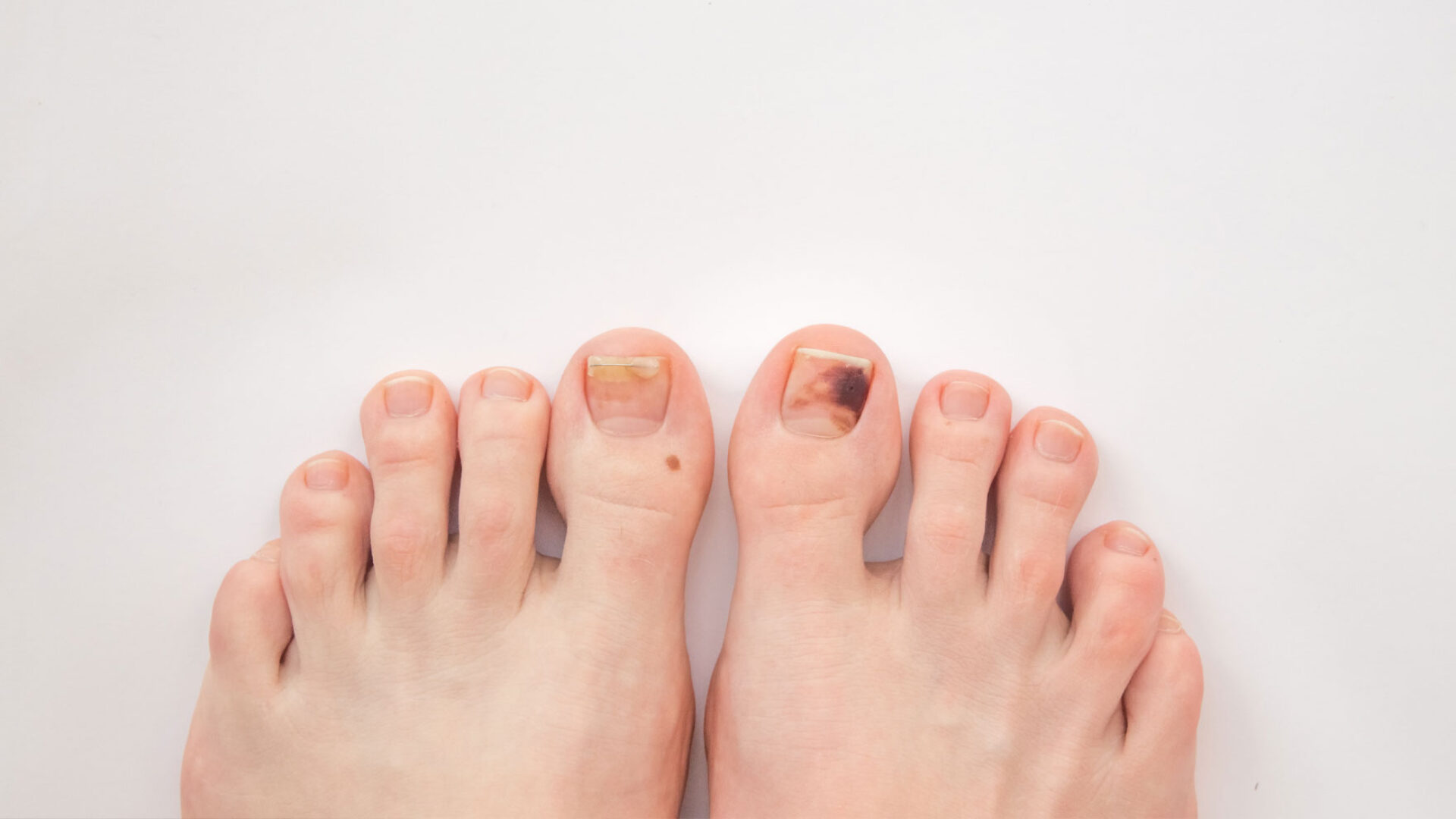 Füße mit Nagelerkrankungen.