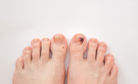 Füße mit Nagelerkrankungen.