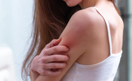 Frau mit Schuppenflechte am Oberarm.